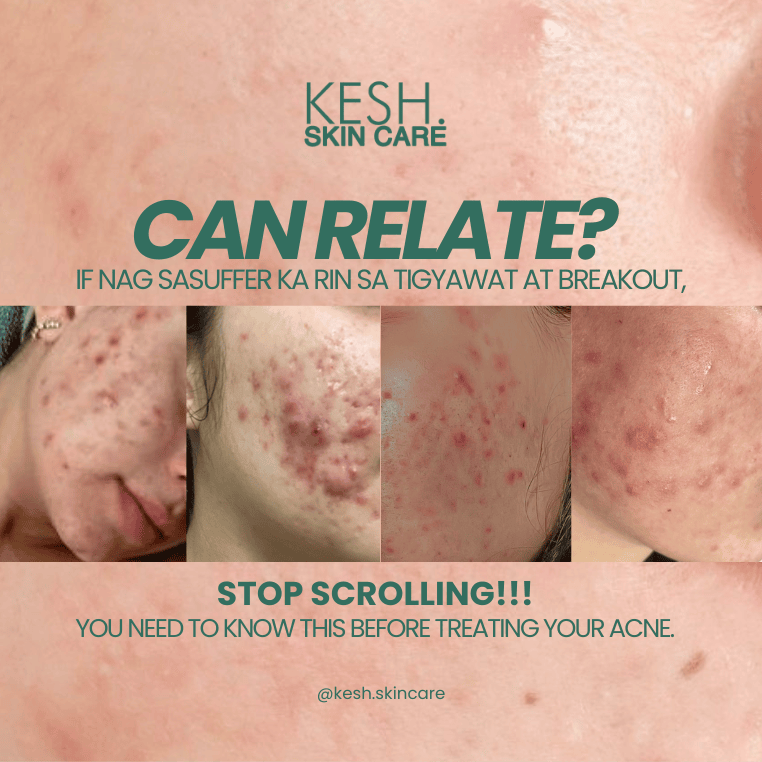 How to Get Rid of Acne Naturally and Effectively
