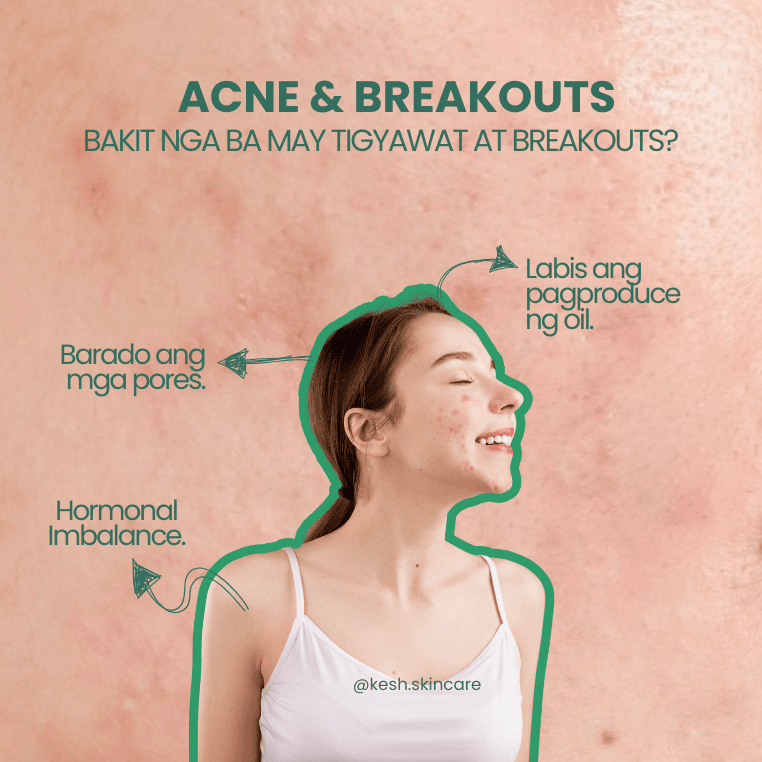 Common Causes of Acne